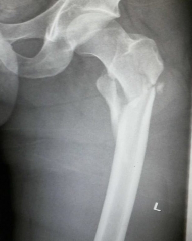 病院に搬送されて撮影されたレントゲン写真。大腿骨骨折との診断